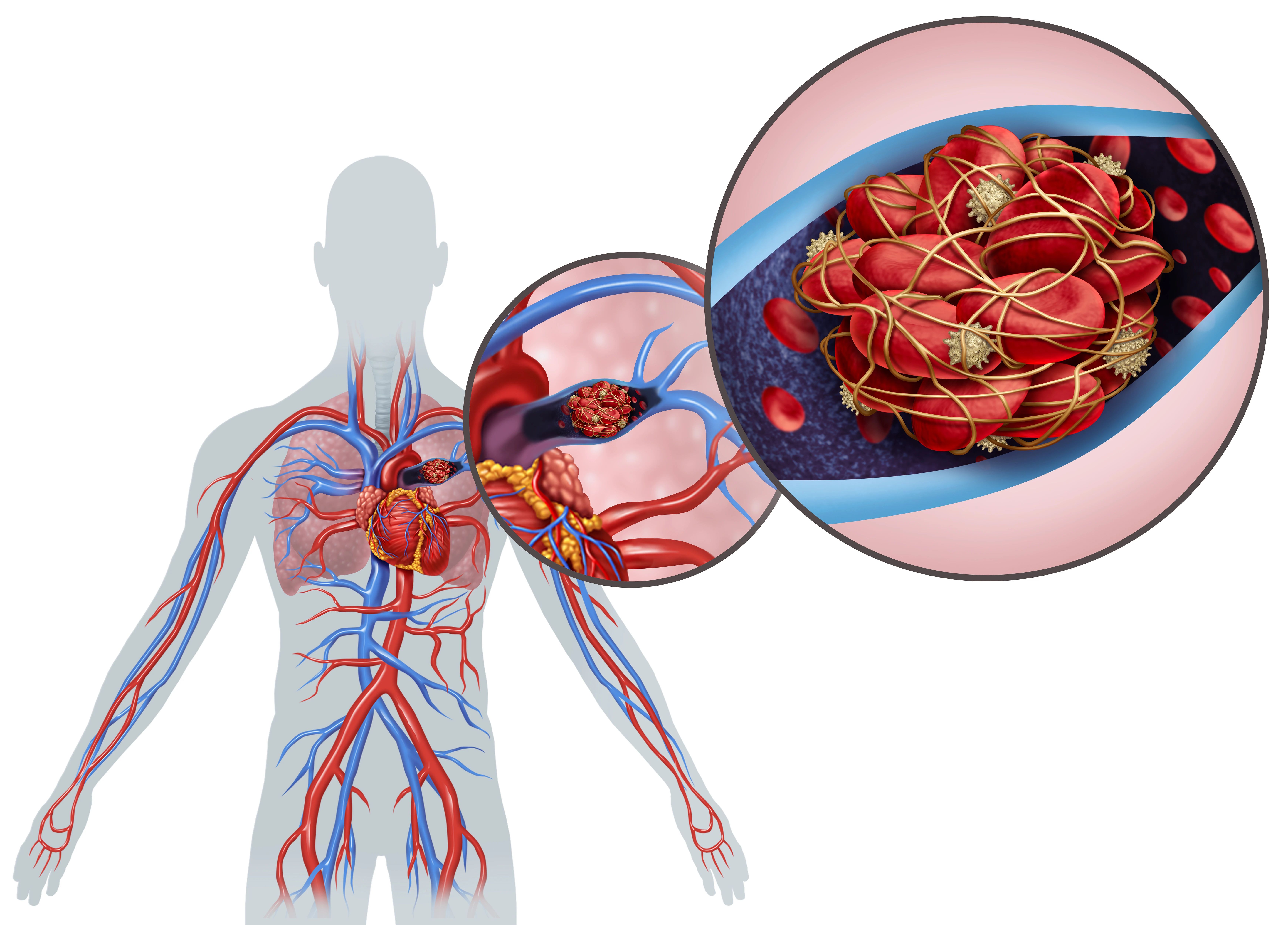 1697596321530802.jpg 血栓11.jpg