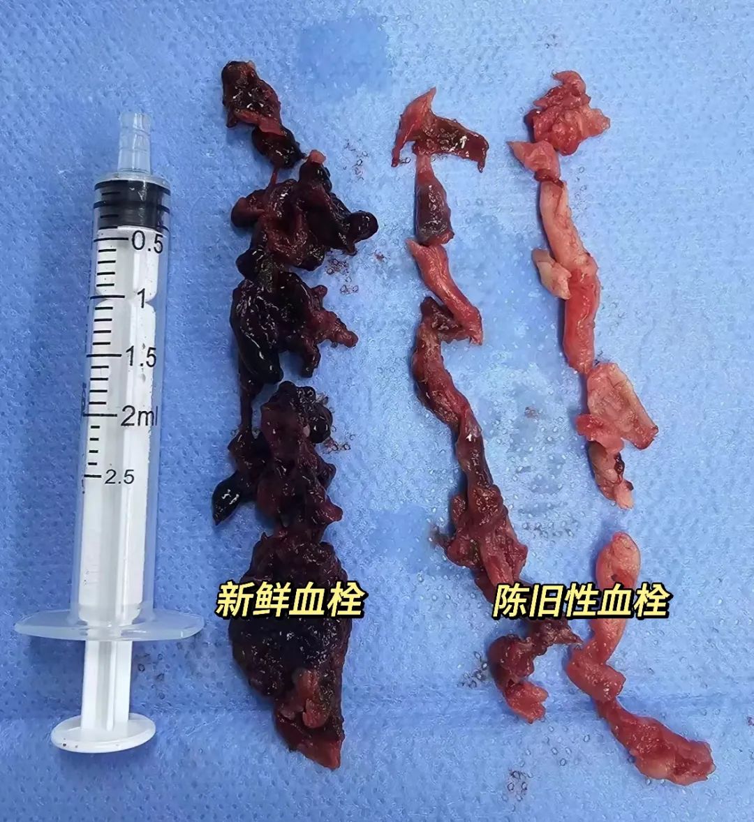 1697596474906503.jpg 血栓7.jpg